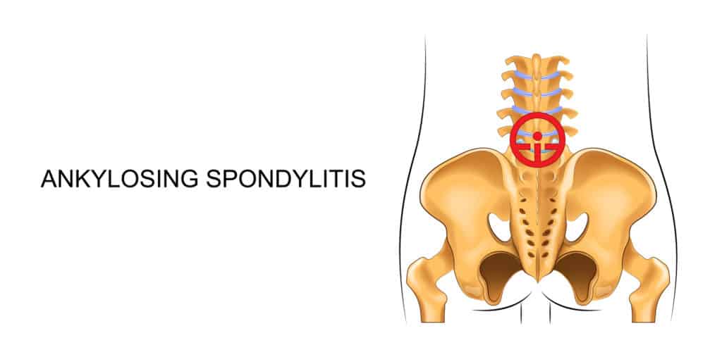 ankylosing spondylitis shown on a diagram