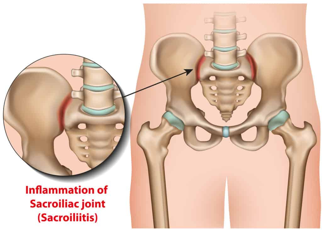 inflammation of sacroiliac joint shown on diagram