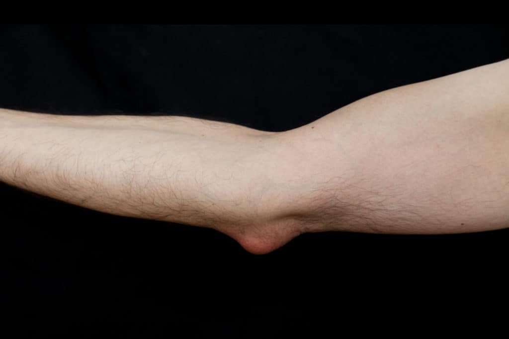 Person with bursitis in their elbow 