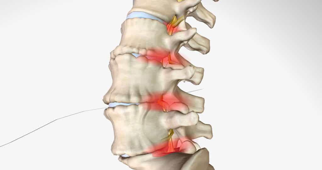 spinal decompression shown on a diagram 