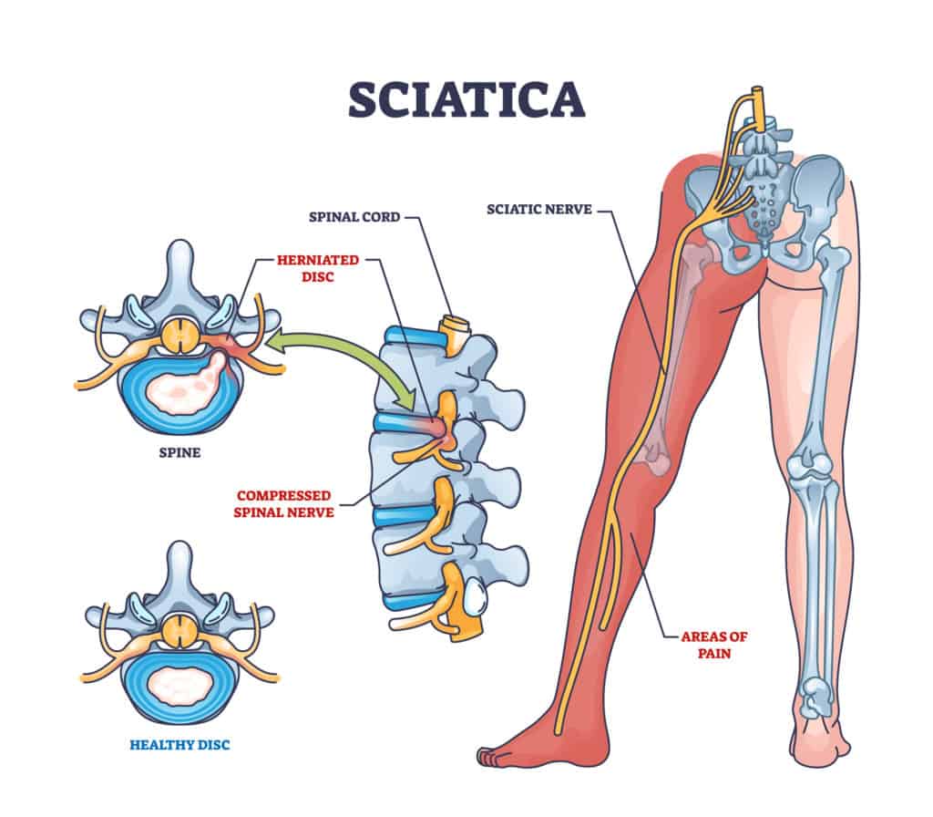 Sciatica as symptom from herniated disc and spinal nerve outline diagram. Labelled educational scheme with medical condition from compressed nerves and compared with healthy disc vector illustration.